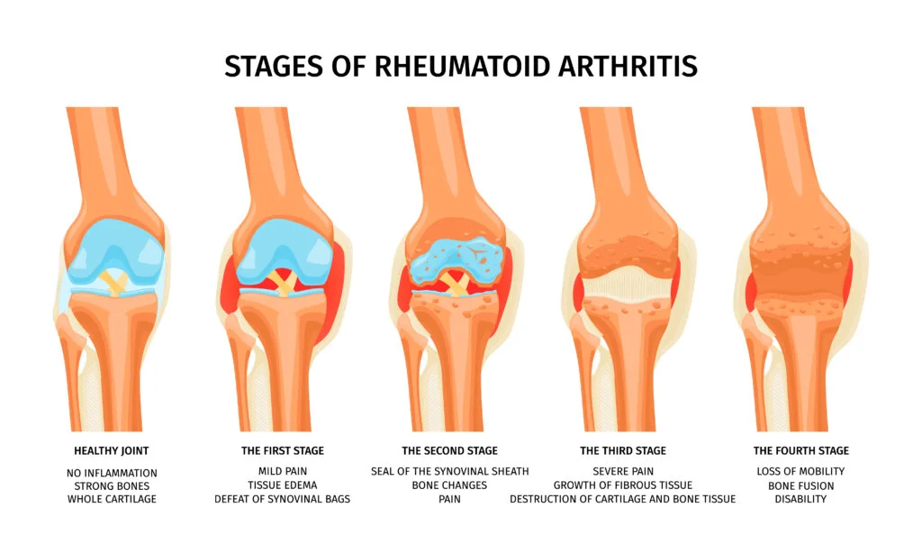 33771046_2209.i504.003.S.m005.c12.realistic-knee-joints-anatomy-rheumatoid-arthritis-stages-1024x614
